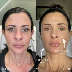 Woman treated with Ellacor - Woman treated with Ellacor