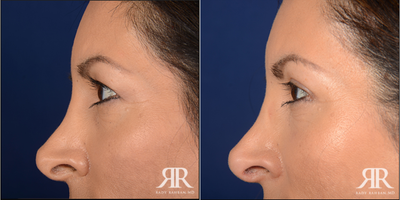 45-54 year old woman treated with Eyelid Surgery - Upper Blepharoplasty