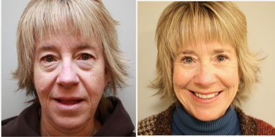 45-54 year old woman treated with Eye Bags Treatment - Upper and lower eyelid blepharoplasty
