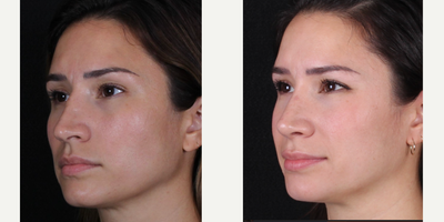 25-34 year old woman treated with Revision Rhinoplasty - Rhinoplasty B&A