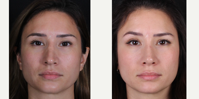 25-34 year old woman treated with Revision Rhinoplasty - Rhinoplasty B&A