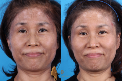 55-64 year old woman treated with Neo Laser - Melasma treated with Neo laser