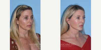 Woman treated with Lip Lift - Woman treated with Deep Plane Facelift, Lip Lift, Facial Fat Transfer, and Eyelid Surgery. Patient is shown before and over a year post-op.