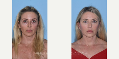 Woman treated with Facial Fat Transfer - Woman treated with Deep Plane Facelift, Lip Lift, Facial Fat Transfer, and Eyelid Surgery. Patient is shown before and over a year post-op.