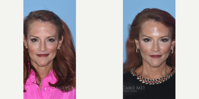 Woman treated with Laser Resurfacing - Woman treated with Facelift, Neck Lift, Facial Fat Transfer, and Laser Resurfacing
