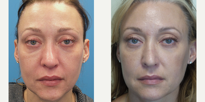 46 year old woman treated with Radiesse - This patient wanted to plump her cheeks and give her eyes a refreshed look.