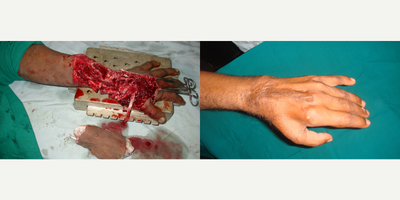 35-44 year old man treated with Hand Reconstructive Surgery - CRUSH INJURY HAND RECONSTRUCTION