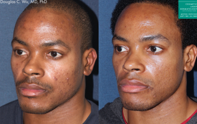 25-34 year old man treated with Intracel - Intracel treatment to address acne scarring and hyperpigmentation in a male patient.