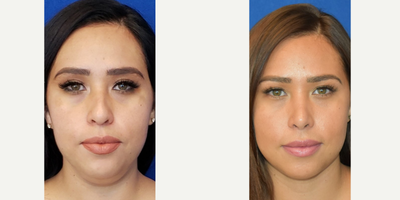 25-34 year old woman treated with Liposuction - Liposuction of the neck