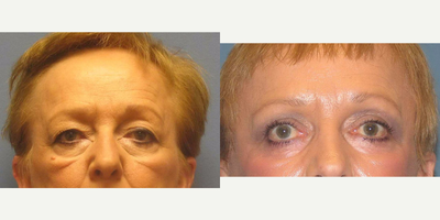 Quicklift w/neck liposuction - The patient was treated with both Quicklift and neck liposuction. The astonishing results are 6 months post-op.