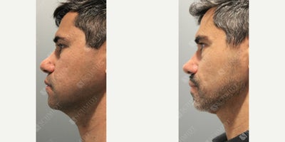 Man treated with Buccal Fat Removal - Subtle transformations for a refined, natural look! This patient desired a subtle change and came in with specific goals: to reduce the fullness in his cheeks, enhance definition in the cheek areas, bring symmetry, and reduce the bulbosity of his nose without losing his masculine appearance. Through cosmetic rhinoplasty, I narrowed and carefully reshaped the nasal tip for enhanced symmetry, performed a septoplasty for improved function, and added cartilage grafts to strengthen airflow. Right and left buccal fat reduction added just the right amount of contour to his cheeks, bringing balance and definition to his entire face. He is shown two years post-op and still enjoying his results.