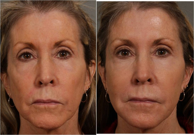 56 year old female after a Liquid Lift using Juvederm Voluma  - 56 year old female, noticing facial sagging along her jaw line, puffiness under her eyes, loss of facial volume along her cheeks and temples, and a sad appearance due to sagging of the corners of her mouth.

	Patient had a non invasive Liquid Lift, a 30 minute single treatment session, using Juvederm Voluma to lift her cheeks, jaw line and fill in the hollowness around her temples. The new micro cannula injection technique was used to minimize bruising. Juvederm was injected along the corners of her mouth and marionette lines taking away the sad appearance that so often is seen when the corners of the mouth droop from loss of support. Her under eye area has almost complete resolution of the puffiness due to Restylane injections in the under eye hollows. Results of her Liquid Lift can last up to 2 years where the Juvederm Voluma was injected. There was little to no downtime.