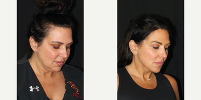 45-54 year old woman treated with Facelift, Deep Plane Facelift, Neck Lift - I love the natural look that I was able to achieve for this beautiful 46 y/o!!! Using a deep plane facelift , platysmaplasty , and deep neck fat removal (under the muscles), I was able to reposition the cheeks slightly higher and create an iconic jawline and neck that highlights her gorgeous eyes and lips!!! Her face now has a more youthful diamond shape.