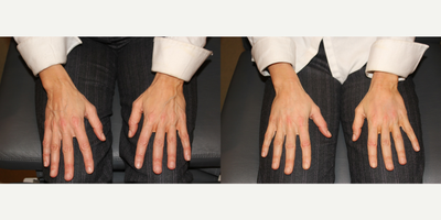 45-54 year old woman treated with Radiesse - My 47 year old athletic patient was concerned about her aging hands. She works out a lot and feels her hands have aged prematurely. Here she is right after radiesse injections to the hands, one in each hand and her hands look wonderfully rejuvenated immediately after.