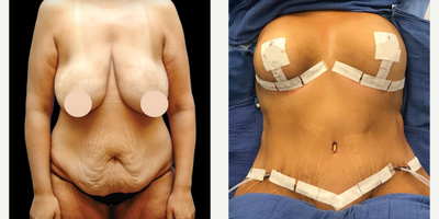Body Lift, Breast Augmentation, Breast Lift - IMMEDIATELY VISIBLE RESULTS after my patient underwent a Body Lift with a Breast Augmentation & Breast Lift..- Able to remove a little over 12 pounds of skin & fat.- Stay tuned for her long-term follow-up photos in about 4 months!