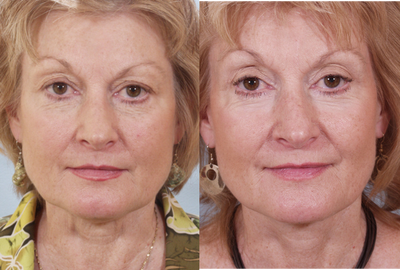 Lower Eyelid Hetter Peel - 
	This patient had Lower Eyelid Resurfacing and Upper Eyelid Surgery along with a Face lift.
