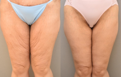 47 year old woman treated with Thigh Lift - 47 year old woman treated with Thigh Lift