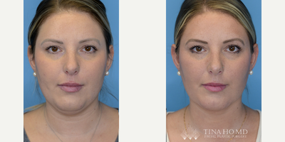 25-34 year old woman treated with Mini Neck Lift, Buccal Fat Removal - 34 year-old female who underwent buccal fat removal and deep mini neck lift for facial contouring as well as jawline contouring and neck rejuvenation.