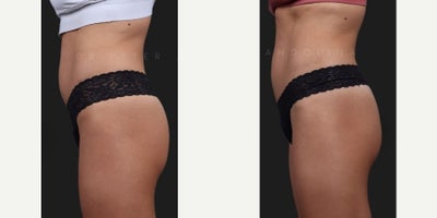 Woman treated with Sculptra Butt Lift, Nonsurgical Butt Lift - A sculptra or non-surgical BBL is a great option and alternative for patients who want to enhance their buttocks without the downtime and commitment associated with surgery. 