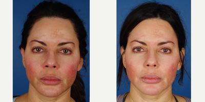 25-34 year old woman treated with Skin Lightening Raval Melanage Peel - 25-34 year old woman treated with Skin Lightening Raval Melanage Peel