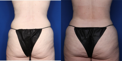 35-44 year old woman treated with Mommy Makeover, Breast Lift with Implants, Natrelle Breast Implants, Tummy Tuck - 42 y/o female shown 6 months after a bilateral breast augmentation and lift with round Natrelle silicone implants (365 cc on R and 415 cc on L) and a tummy tuck with liposuction.