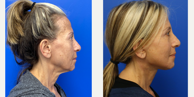 55-64 year old woman treated with Deep Plane Facelift - 58-year-old patient 3 weeks after Facelift, Neck lift, and co2 laser. She had an upper eyelid blepahroplasty donea year and a half ago as well.