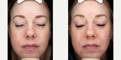 35-44 year old woman treated with Moxi - 1 MOXI Treatment