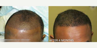 Man treated with Hair Transplant, ARTAS Robotic Hair Transplant - Man treated with Hair Transplant, ARTAS Robotic Hair Transplant