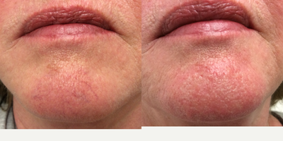 45-54 year old woman treated with Vein Treatment - VeinGogh treatment done on the face. The after picture was taken immediately after the treatment. The redness will resolve gradually over the next 24-48 hrs. VeinGogh works best on those fine spider veins that are sometimes just too tiny to treat with sclerotherapy.