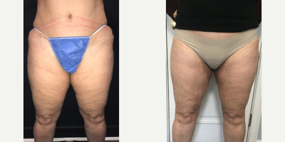Woman treated with Vaser Liposuction - Woman treated with Vaser Liposuction