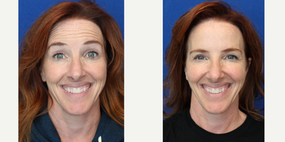 Woman treated with Botox - Woman treated with Botox
