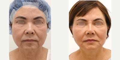 55-64 year old woman treated with MACS Facelift, Eyelid Surgery, Buccal Fat Removal, Rhinoplasty - A female patient underwent a transformative journey in January 2025 with Facelift, Buccal Fat Removal, and Lower Eyelid Surgery by Dr. Charles Lee in San Francisco, CA. This patient also received a rhinoplasty with a nasal implant. Post-surgery, she exhibited a rejuvenated appearance, with well-defined facial contours and rejuvenated eyes. Her recovery was smooth, and she expressed satisfaction with the results, citing increased confidence and a more youthful aesthetic. Dr. Lee's expertise and the patient's positive outcome exemplify the benefits of these cosmetic procedures in enhancing one's natural beauty.