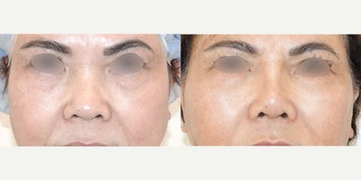 45-54 year old woman treated with Asian Rhinoplasty, Rhinoplasty - A female patient underwent rhinoplasty with a nasal implant in winter 2025 in San Francisco, CA, by Dr. Charles Lee. This patient also had a facelift, lower blepharoplasty, and buccal fat removal. The procedure yielded successful results, enhancing her facial features. The patient expressed satisfaction with the outcome, highlighting improved self-confidence and a positive self-image. Dr. Lee's expertise and care contributed to a smooth recovery process, leaving the patient delighted with the overall experience.