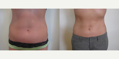 Laser Liposuction - Abdomen - Abdomen