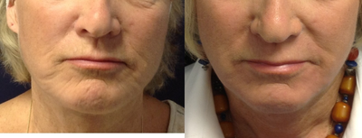 Fraxel CO2 repair laser resurfacing for wrinkles around the mouth - Fraxel CO2 repair laser resurfacing for wrinkles around the mouth