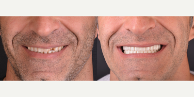 35-44 year old man treated with Dental Implants, Smile Makeover, Dental Bone Graft, Dental Crown - 12 implants with 24 zirconia crown
