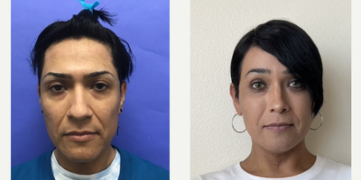 Patient treated with Transgender Facial Feminization Surgery, Facial Feminization Surgery, Rhinoplasty, Septoplasty - 35 to 44 year-old female patient is 3.5 months post-op from Facial Feminization surgery. Her procedures included: Forehead Lift, Hairline Lowering, Orbital Bony Contouring, Septorhinoplasty (closed) with Cartilage Grafts and Weirs, Chin Reduction and Contour, Voice Feminization Surgery and Thyroid Cartilage Shave.