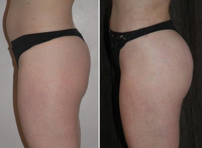 Brazilian Butt Lift with BodyTite liposuction - This 50 year-old woman is very physically active and maintains a healthy lifestyle. After pregnancy and passage of time she lost volume in her buttock region and developed a flatter shape with poor definition. Her goal was to improve the shape and proportion of this area but still maintain a natural, tasteful appearance. She elected to proceed with a Brazilian Buttock lift, with liposuction performed to the abdomen, waist, lower back and love handles. The fat was purified in the operating room and transferred to the mid and upper buttock region. Approximately 500cc of fat was transferred to each side, achieving a rounder, fuller, and more youthful appearance.