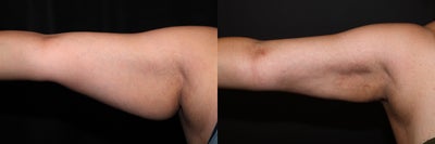 Laser Liposuction - Upper Arms - 
	Laser Liposuction - Upper Arms
