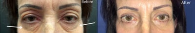 Woman treated with Eyelid Surgery - Woman treated with Eyelid Surgery