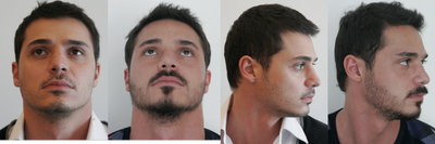 Beard Transplantation-6 Months - 	3400 grafts beard transplantation 8 and half hour surgery under local anesthesia.