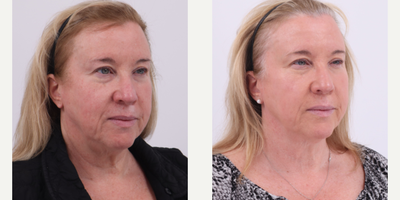 55-64 year old woman treated with BroadBand Light (BBL) - Before and after 2 sessions of BBL to treat rosacea and uneven skin tone