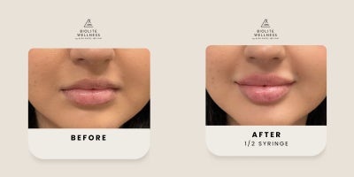 18-24 year old woman treated with Revanesse, Lip Fillers, Juvederm, Restylane - Before and after of 1/2 syringe of lip filler used for lip balancing