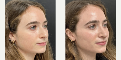 Woman treated with Rhinoplasty - Woman treated with Rhinoplasty