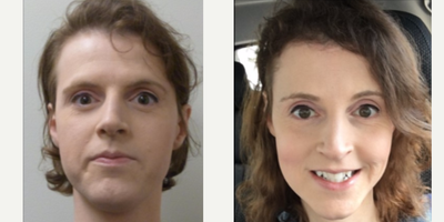 25-34 year old woman treated with Facial Feminization Surgery - 25-34 year old woman treated with Facial Feminization Surgery