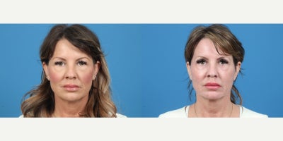 45-54 year old woman treated with Skin Rejuvenation - Full face CO2 laser rejuvenation