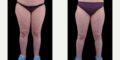 Woman treated with Lipedema Surgery - Woman treated with Lipedema Surgery