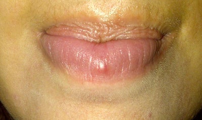 Ask an Expert: Small pimple-like bump inside of lower lip