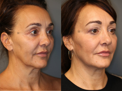 Pan Facial Rejuvenation - Upper and lower lid filler, temple and jawline rejuvenation.