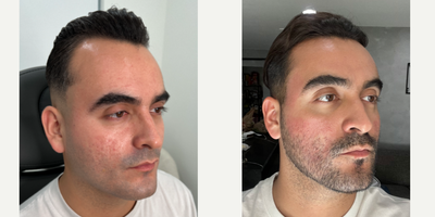 25-34 year old man treated with CO2 Laser, Punch Excision, Fractional Laser - My patient had always dreamed of reducing these harsh scars, which made him feel very self-conscious. He wanted to be treated for years but did not trust anyone in Florida to help him because he knew he was a sensitive skin type.  He had been following me for some time then came to me as soon as he saw that we visit MIAMI.  After one combination treatment, we saw a substantial improvement, but we have a game-plan to target the rest of them. The key is our skincare regimen - it's important to use between treatments.  ACNE SCAR COMBINATION  Punch Excision  Fractional laser  CO2 LASER EmerSkinTAG A BEST FRIEND WHO MAY WANT THIS TREATMENT 